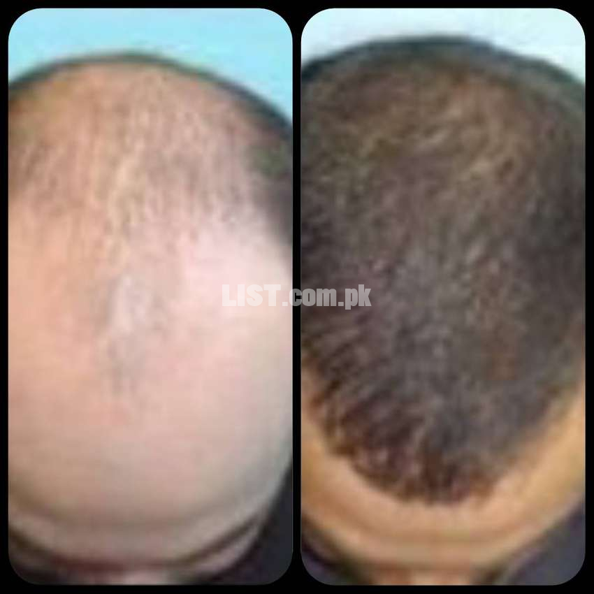 Best PRP Clinic in Karachi. Best Hair loss treatment in Rs.9,999/-