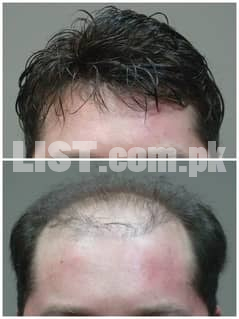 Hair patch hair system for sale in Karachi