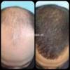 Best PRP Clinic in Karachi. Best Hair loss treatment in Rs.9,999/-
