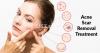 Acne scar removal treatment in Hyde