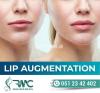 Lip Filler Treatment in Islamabad, Lip Fillers Injections - RMC