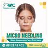 Microneedling Therapy in Islamabad - Best Microneedling Treatment -RMC