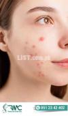 Laser Treatment For Acnes cars in Islamabad - Acnes cars Removal - RMC